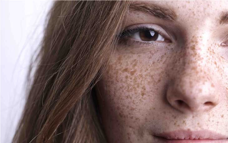Is Freckles Dangerous Or Not: Things You Need To Know