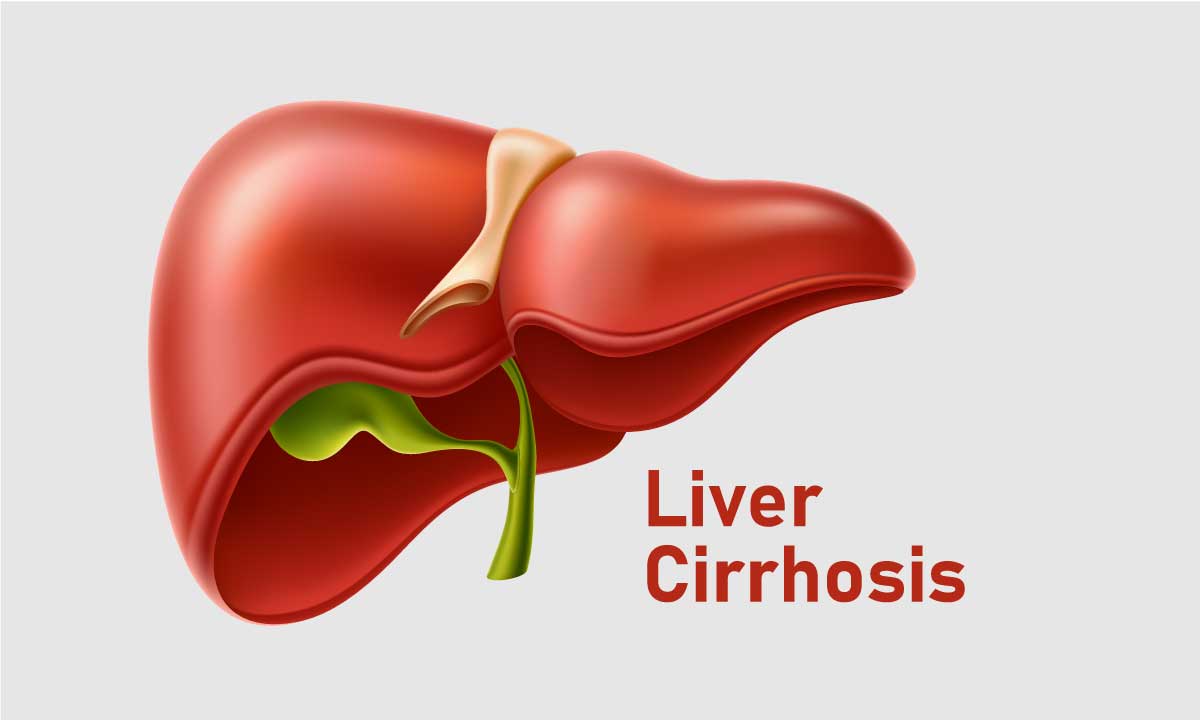 Liver Cirrhosis: Most Relevant Facts About Cirrhosis