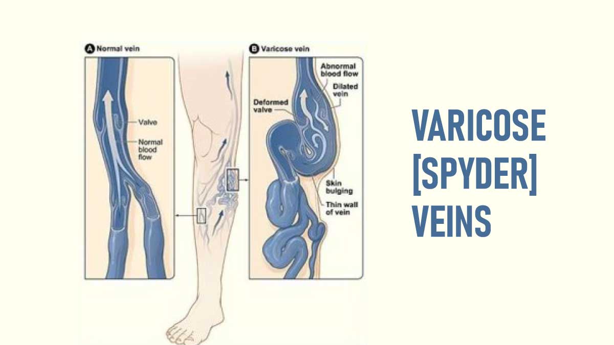 Varicose[Spyder]Veins: Things You Need To Know!