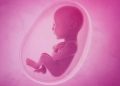 Oligohydraminos : Low amniotic fluid symptoms and signs