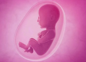 Oligohydraminos : Low amniotic fluid symptoms and signs