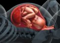 Polyhydraminos : high amniotic fluid levels ,borderline high amniotic fluid