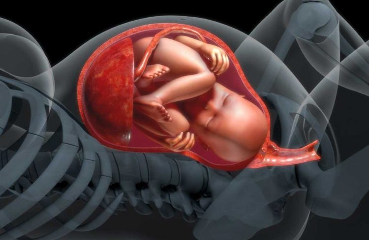 Polyhydraminos : high amniotic fluid levels ,borderline high amniotic fluid