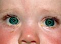 Conjunctivitis, conjunction ,subordinating conjunctions, coordinating conjunction.