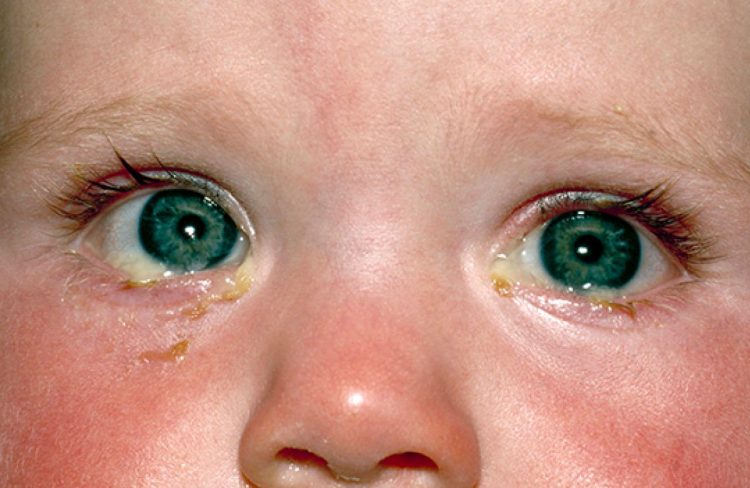 Conjunctivitis, conjunction ,subordinating conjunctions, coordinating conjunction.